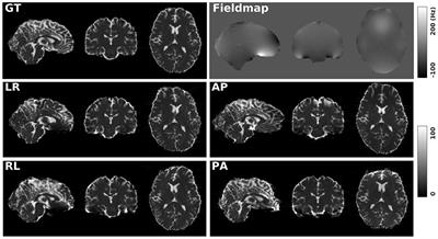 Evaluation of Six Phase Encoding Based Susceptibility Distortion Correction Methods for Diffusion MRI